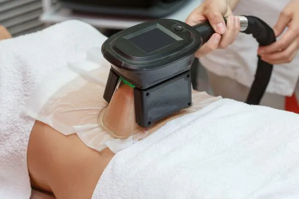 Image of person having fat freezing treatment to help weight gain Chesterfield