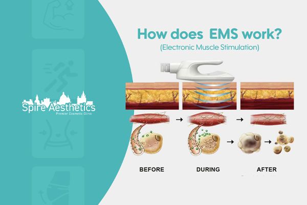 EMS treatment for post pregnancy weight loss treatment Chesterfield
