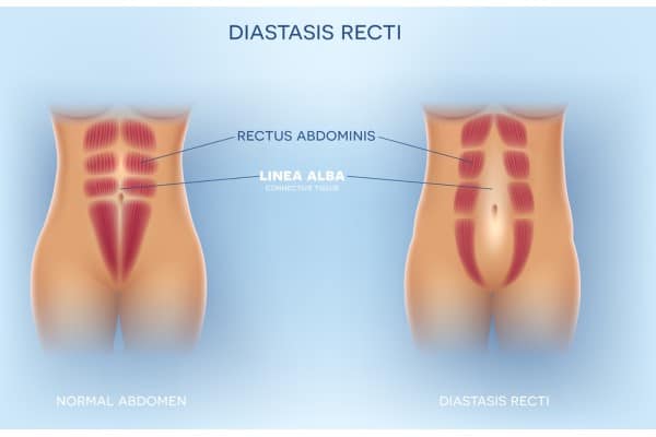 What Non-Surgical Options Are Available for Diastasis Recti Chesterfield?