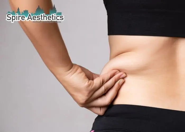 Image of woman pinching fat on their hips Chesterfield. Fat Freezing treatment