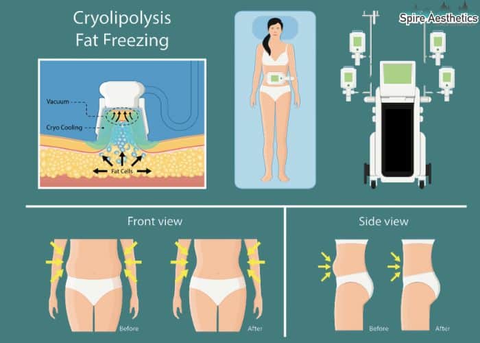 Image of diet and fat freezing combined for best results for Spire Aesthetics Chesterfield