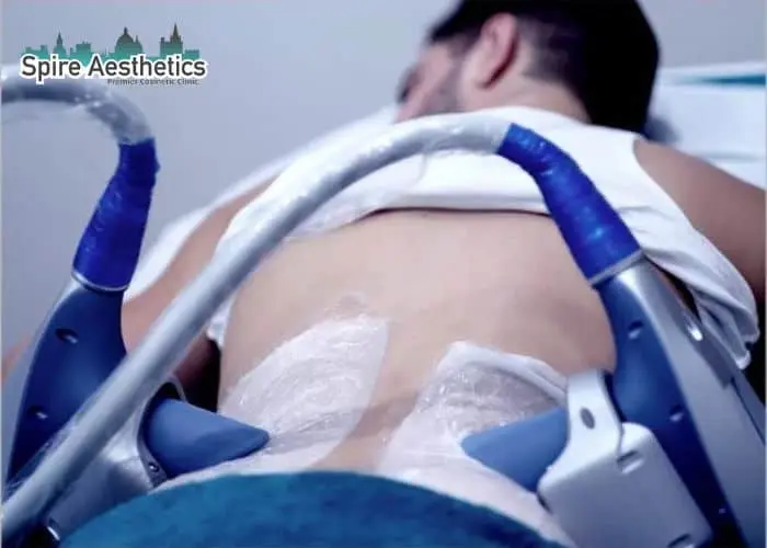 Man having fat freezing treatment done on love handles before a competitions Chesterfield to create a sculpted look.
