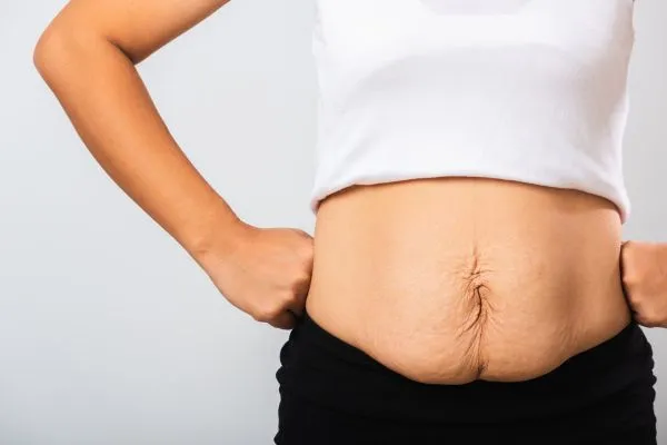Image of a woman's stomach after weight loss with sagging skin following a gastric band Chesterfield