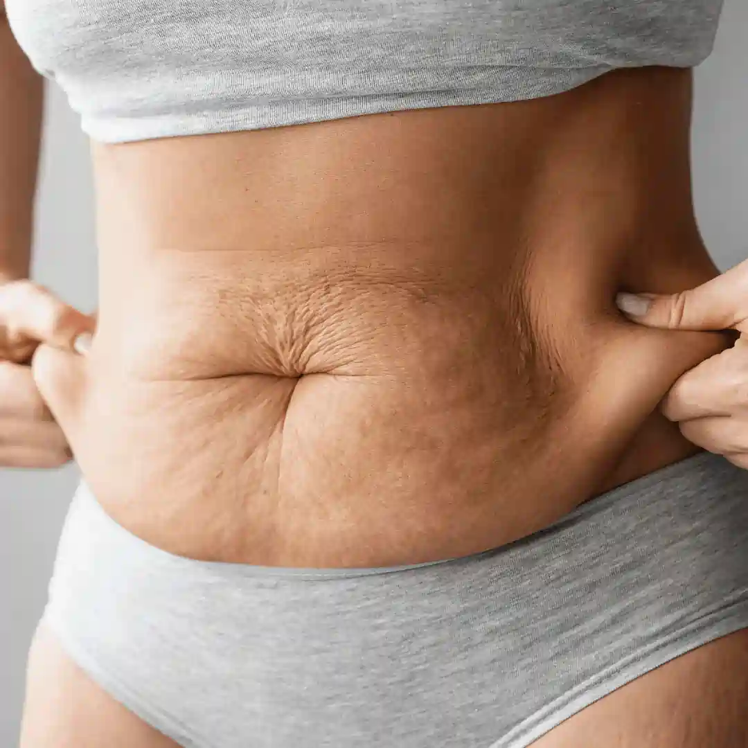 Is It Normal to Have Loose Skin After Pregnancy Chesterfield?