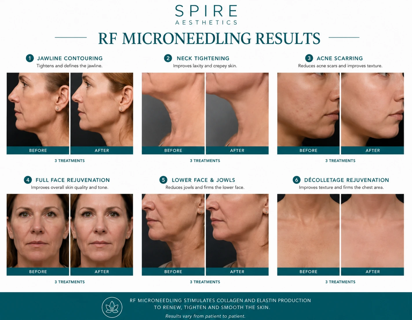 RF Microneedling Skin tightening Chesterfield results