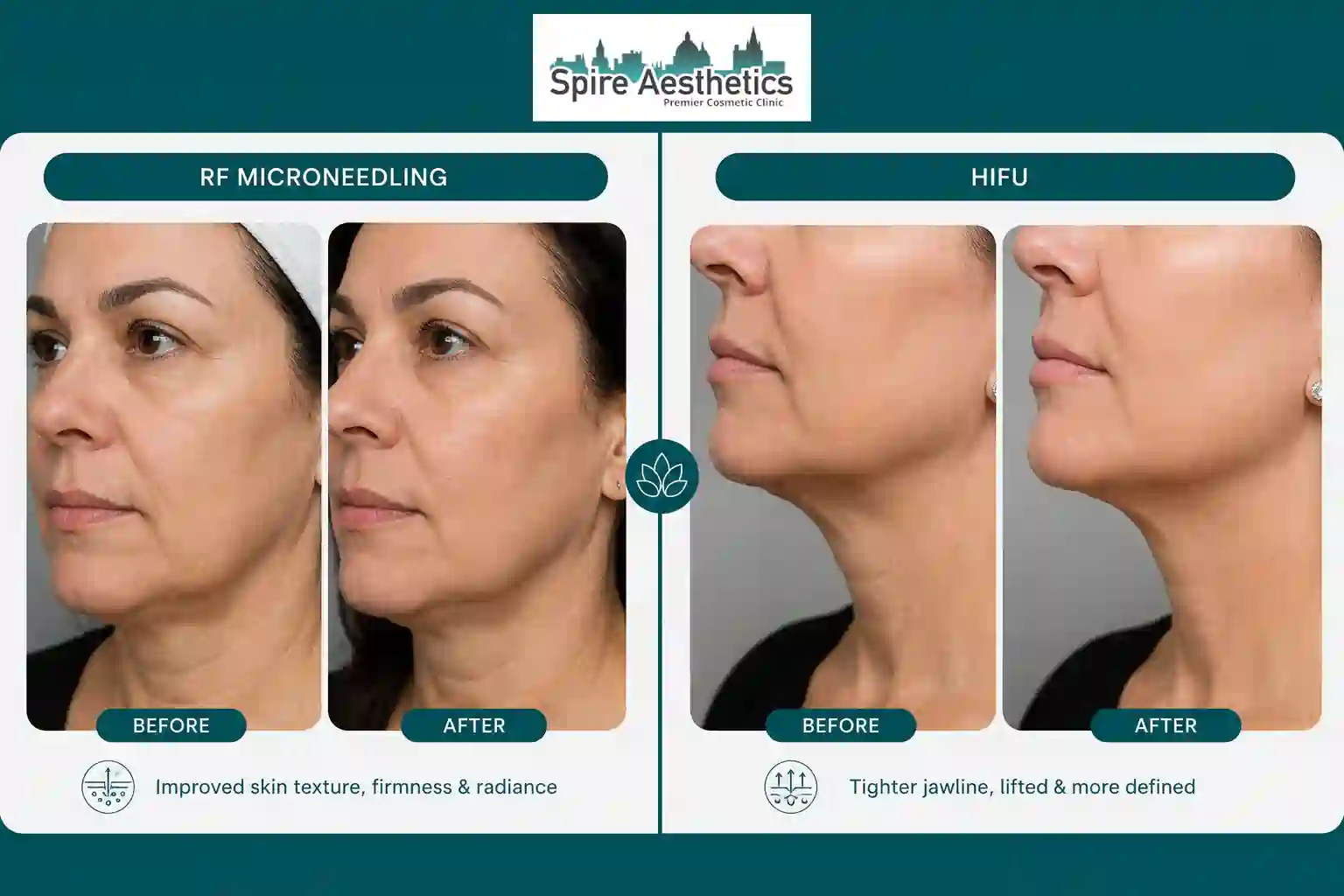Can RF Microneedling and HIFU Be Combined Chesterfield?