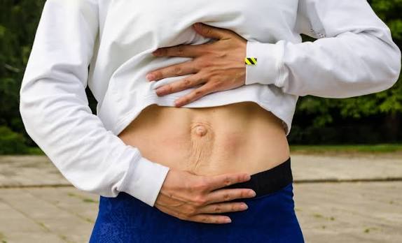 When Could Diastasis Recti Be the Missing Piece of the Puzzle Chesterfield?